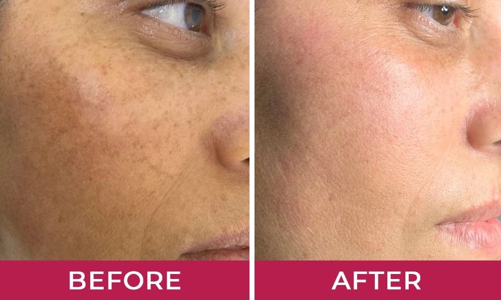Hydralyft Face Mask Benefits